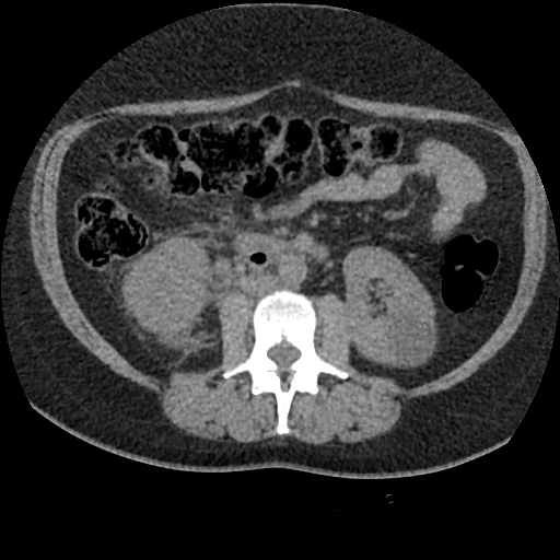 Acute cholecystitis and ureteric colic (Radiopaedia 42330-45444 Axial prone 49).jpg