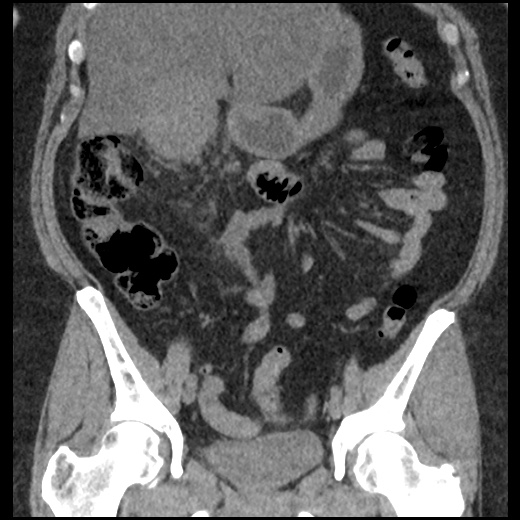 Acute cholecystitis and ureteric colic (Radiopaedia 42330-45444 Coronal prone 44).jpg