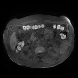 Acute cholecystitis complicated by pylephlebitis (Radiopaedia 65782-74915 Axial T1 fat sat 71).jpg