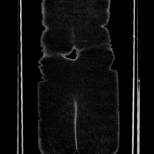 Acute diverticulitis - transverse colon (Radiopaedia 87063-103327 Coronal C+ portal venous phase 160).jpg