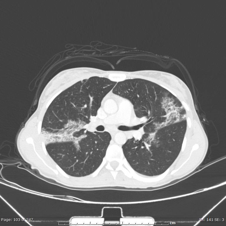 Acute eosinophilic pneumonia (Radiopaedia 48211-53073 Axial lung window 37).jpg