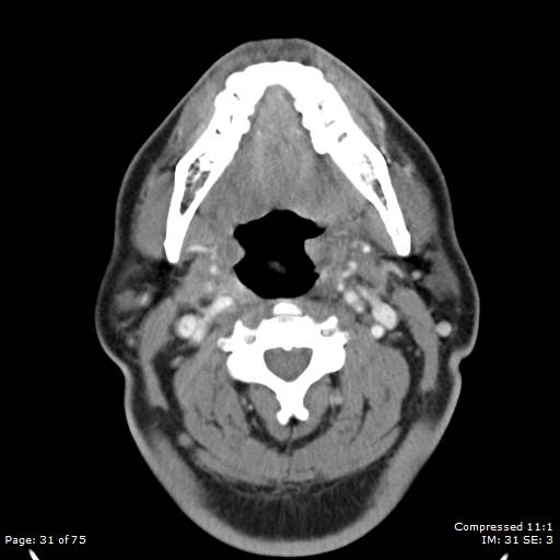 Acute epiglottitis (Radiopaedia 54375-60590 Axial C+ arterial phase 31).jpg