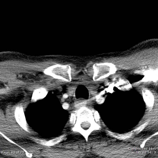 Acute epiglottitis (Radiopaedia 54375-60590 Axial C+ arterial phase 62).jpg