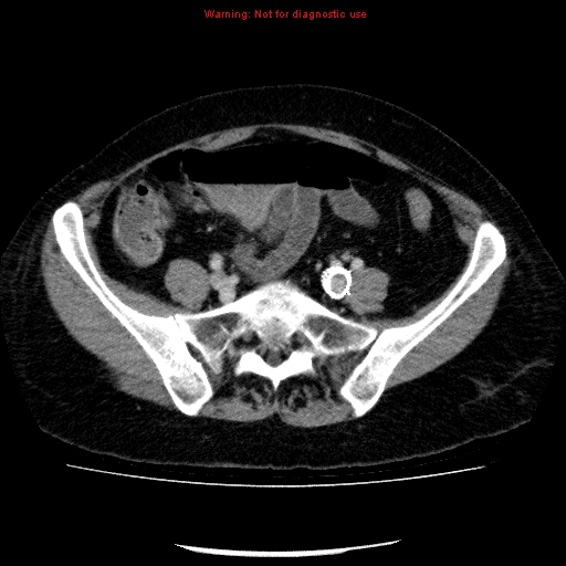 Acute gangrenous cholecystitis (Radiopaedia 10123-10661 Axial C+ portal venous phase 76).jpg