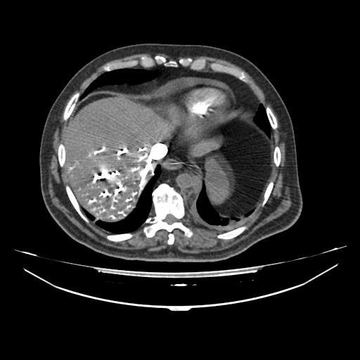 Acute heart failure (CT) (Radiopaedia 79835-93075 Axial C+ arterial phase 60).jpg