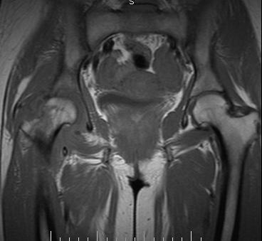 File:Acute hip arthritis (Radiopaedia 5460-7188 Coronal T1 1).jpg