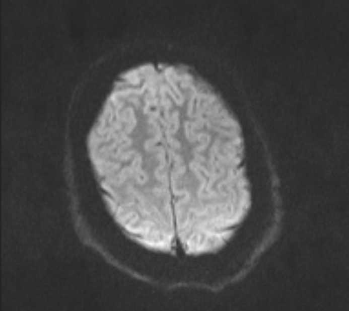 Acute ischemic stroke - posterior circulation territory (Radiopaedia 77670-89880 Axial DWI 43).jpg