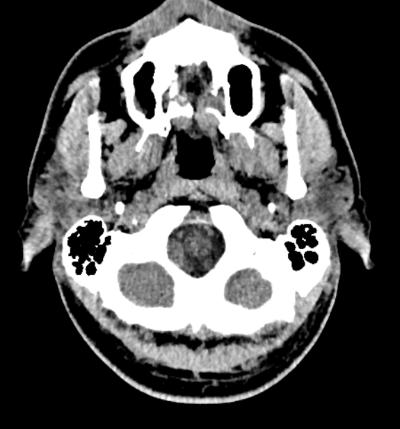 Acute ischemic stroke - posterior circulation territory (Radiopaedia 77670-89881 non-contrast 5).jpg