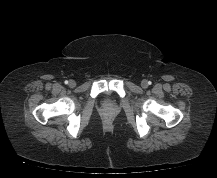 Acute mesenteric ischemia (Radiopaedia 80029-93316 Axial C+ arterial phase 136).jpg
