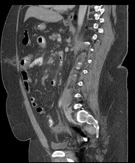 Acute mesenteric venous ischemia (Radiopaedia 46041-50383 Sagittal C+ portal venous phase 67).jpg