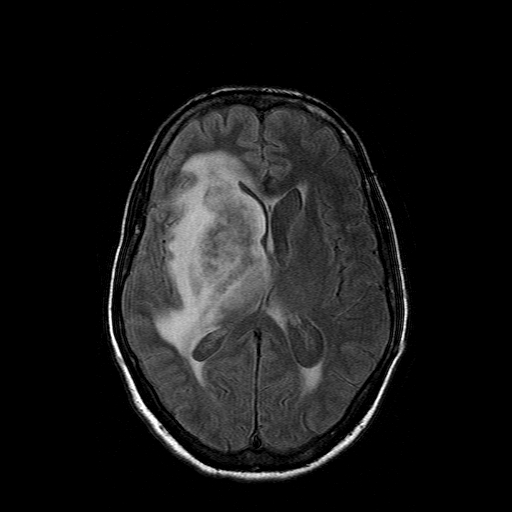 File:Acute necrotizing toxoplasma encephalitis (Radiopaedia 10683-11149 Axial FLAIR 8).jpg