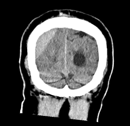 Acute on chronic subdural hematoma (Radiopaedia 78346-90966 Coronal non-contrast 58).jpg