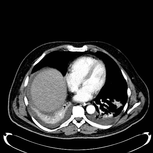 File:Acute pancreatic necrosis (Radiopaedia 13560-18500 Axial C+ portal venous phase 11).jpg