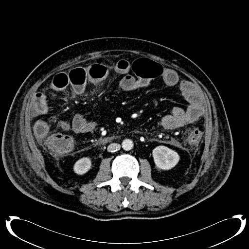 Acute pancreatic necrosis (Radiopaedia 13560-18500 Axial C+ portal venous phase 83).jpg