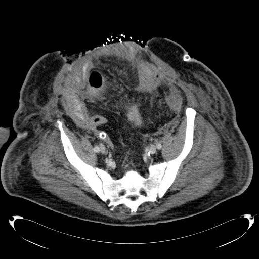 Acute pancreatic necrosis (Radiopaedia 13560-18503 Axial C+ portal venous phase 65).jpg
