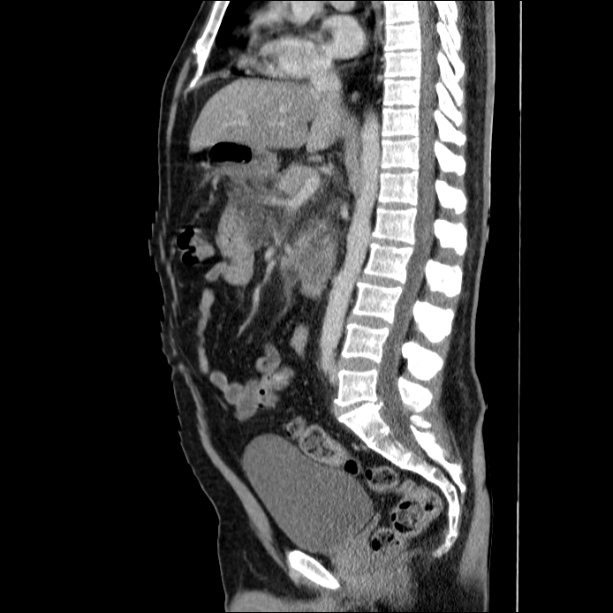 Acute pancreatitis (Radiopaedia 26663-26813 Sagittal C+ portal venous phase 38).jpg