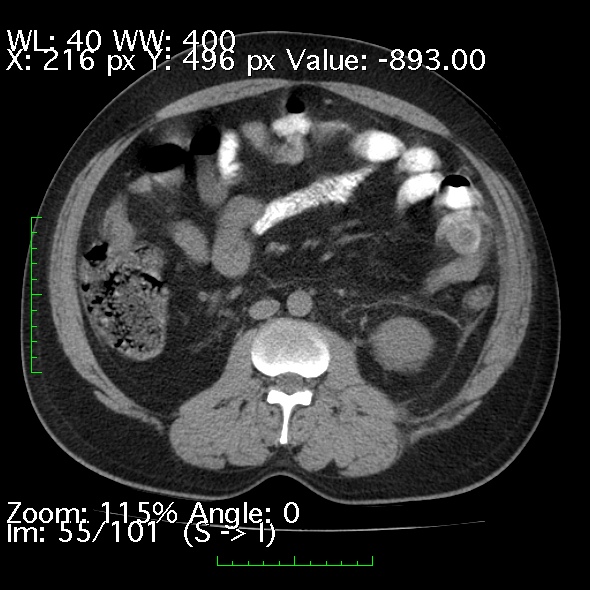 Acute pancreatitis (Radiopaedia 34043-35276 Axial non-contrast 55).jpg