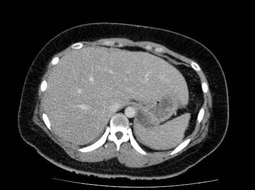 Acute pancreatitis (Radiopaedia 69236-79012 Axial C+ portal venous phase 19).jpg