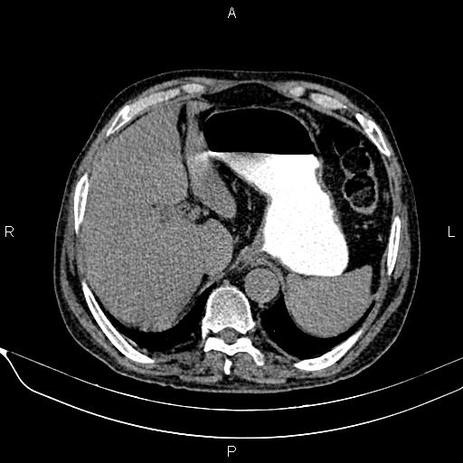 Acute pancreatitis (Radiopaedia 85146-100701 Axial non-contrast 27).jpg