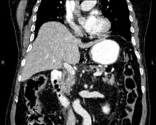Acute pancreatitis (Radiopaedia 85146-100701 Coronal C+ portal venous phase 37).jpg