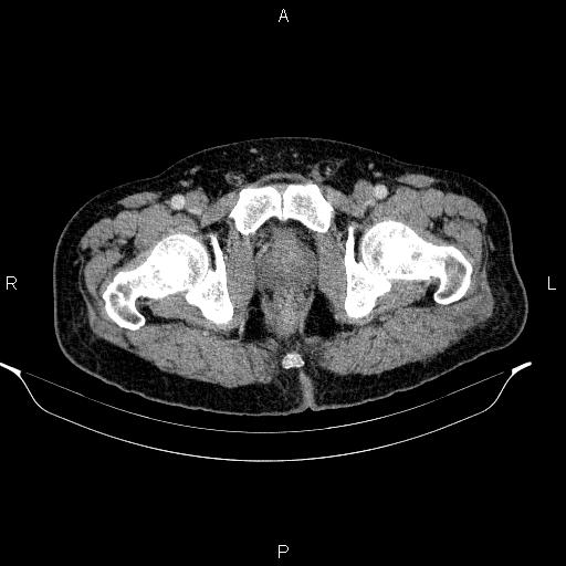 File:Acute pancreatitis (Radiopaedia 85390-101010 Axial C+ portal venous phase 109).jpg
