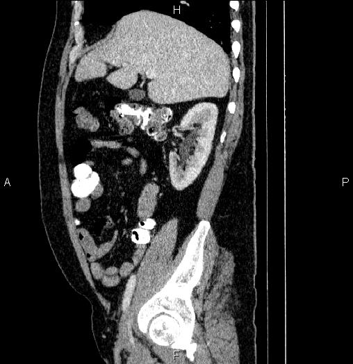 Acute pancreatitis (Radiopaedia 85390-101010 Sagittal C+ portal venous phase 28).jpg