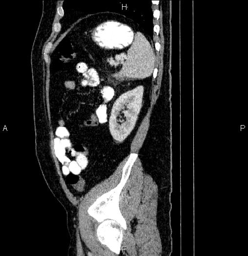 Acute pancreatitis (Radiopaedia 85390-101010 Sagittal C+ portal venous phase 83).jpg