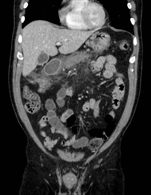 Acute pancreatitis - Balthazar E (Radiopaedia 23080-23110 Coronal C+ portal venous phase 24).jpg