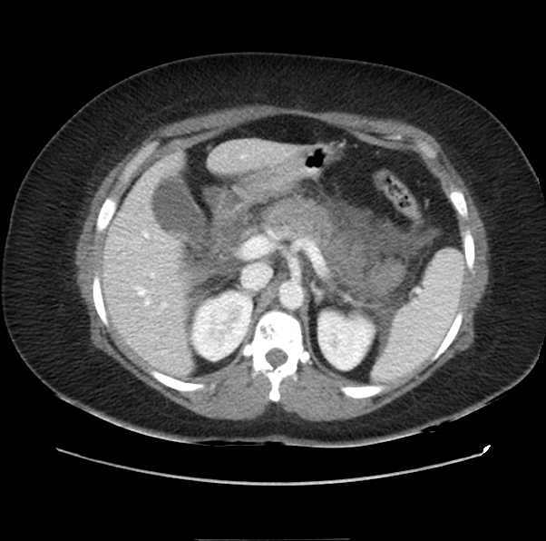 File:Acute pancreatitis - Balthazar E (Radiopaedia 29016-29377 Axial C+ portal venous phase 21).png