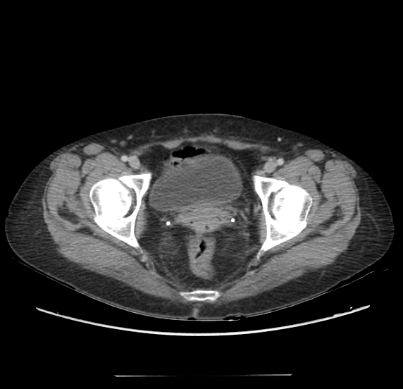 File:Acute pancreatitis - Balthazar E - post ERCP (Radiopaedia 27562-27772 Axial C+ portal venous phase 72).png