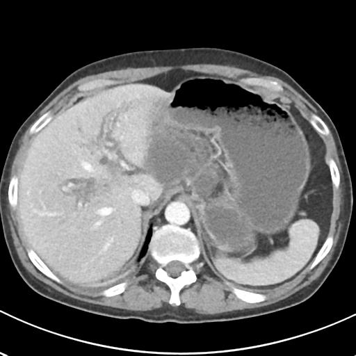 File:Acute pancreatitis and walled-off necrosis (Radiopaedia 29888-30404 Axial C+ portal venous phase 17).jpg