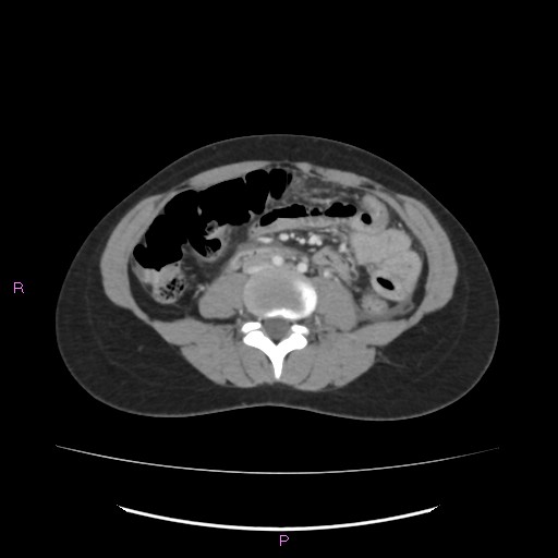 Acute pancreatitis secondary to stone at minor papilla and pancreatic divisum (Radiopaedia 76570-88333 Axial C+ portal venous phase 43).jpg