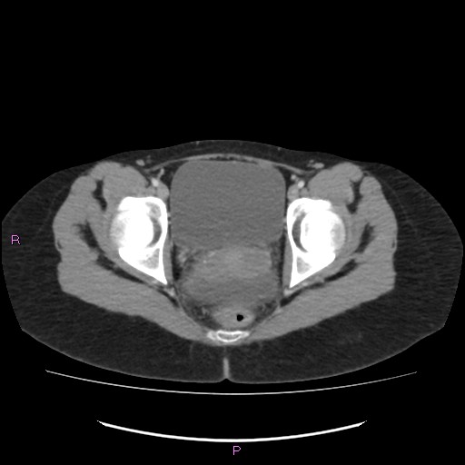 Acute pancreatitis secondary to stone at minor papilla and pancreatic divisum (Radiopaedia 76570-88333 Axial C+ portal venous phase 75).jpg