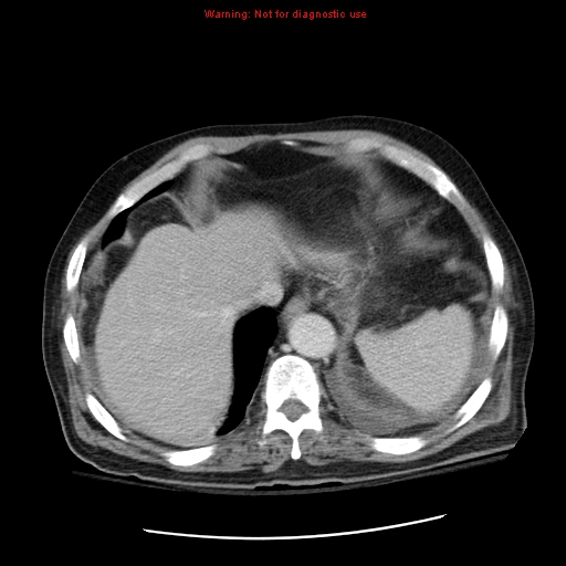File:Acute pancreatitis with incidental pancreatic lipoma (Radiopaedia 10190-10730 Axial C+ portal venous phase 8).jpg