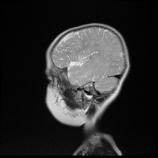 File:Acute phase of hemiconvulsion-hemiplegia epilepsy syndrome (Radiopaedia 29309-29745 Sagittal T2 5).jpg
