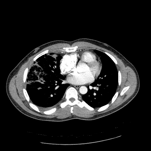 Acute segmental pulmonary emboli and pulmonary infarction (Radiopaedia 62264-70444 Axial C+ CTPA 69).jpg