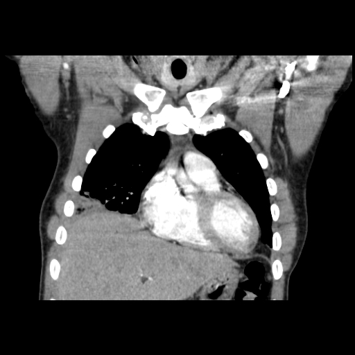 File:Acute segmental pulmonary emboli and pulmonary infarction (Radiopaedia 62264-70444 Coronal C+ CTPA 11).jpg