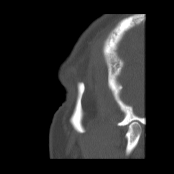 Acute sinusitis (Radiopaedia 23161-23215 Sagittal bone window 60).jpg