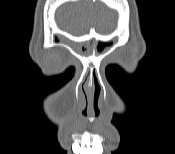 Acute sinusitis (Radiopaedia 40564-43158 Coronal bone window 2).jpg