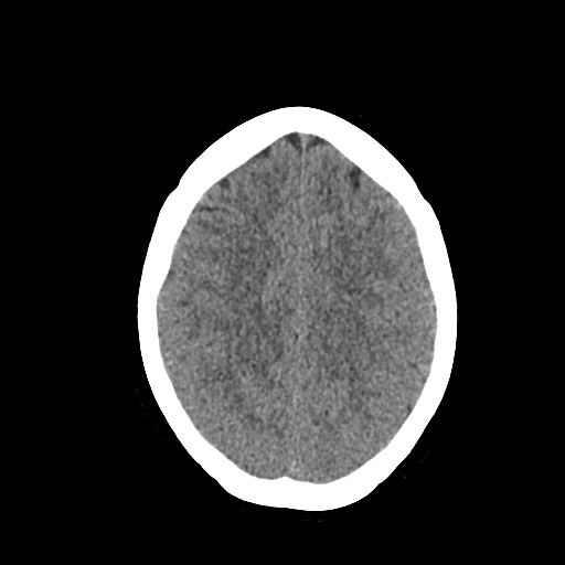 Acute subarachnoid hemorrhage and accessory anterior cerebral artery (Radiopaedia 69231-79008 Axial non-contrast 38).jpg