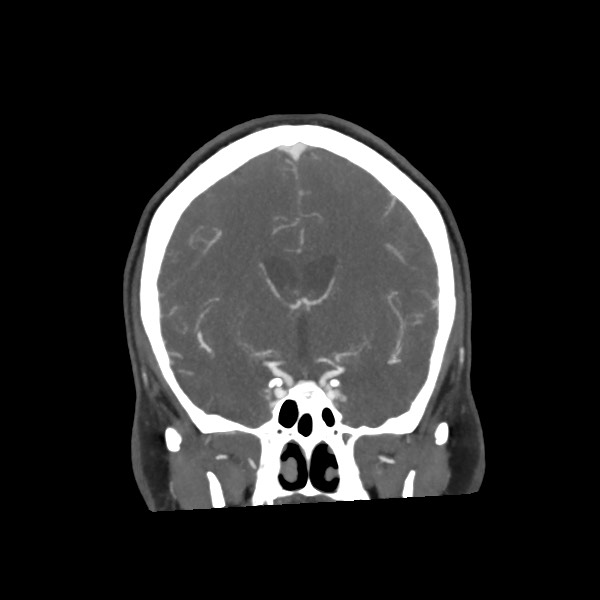 Acute subarachnoid hemorrhage and accessory anterior cerebral artery (Radiopaedia 69231-79009 Coronal C+ arterial phase 37).jpg