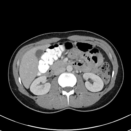 File:Acute uncomplicated appendicitis (Radiopaedia 61374-69304 Axial C+ portal venous phase 45).jpg