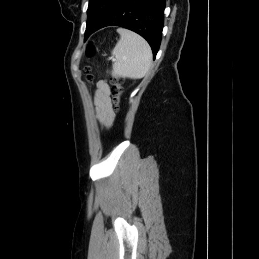 Acute uncomplicated appendicitis (Radiopaedia 73704-84499 Sagittal C+ portal venous phase 164).jpg