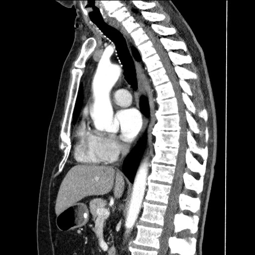 Adenocarcinoma of the lung (Radiopaedia 59871-67325 Sagittal C+ arterial phase 51).jpg