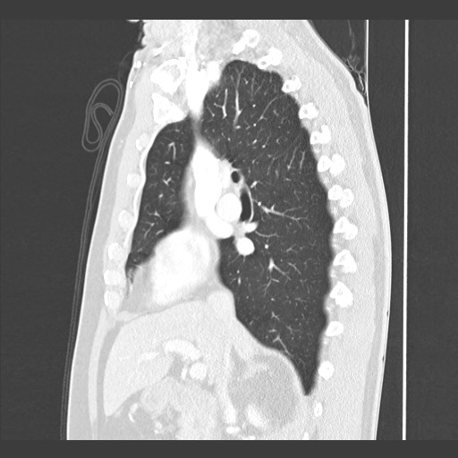 Adenocarcinoma of the lung (Radiopaedia 59871-67325 Sagittal lung window 40).jpg