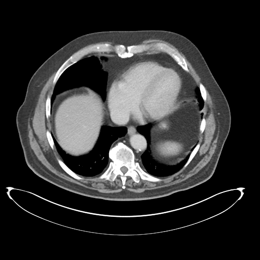 Adenocarcioma of rectum- T1 lesion (Radiopaedia 36921-38547 Axial C+ portal venous phase 10).png