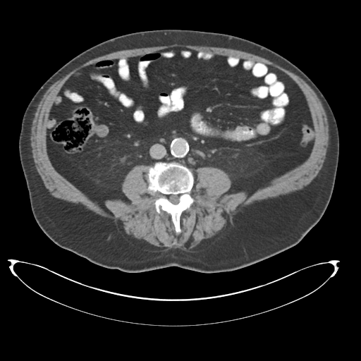 Adenocarcioma of rectum- T1 lesion (Radiopaedia 36921-38547 Axial C+ portal venous phase 50).png