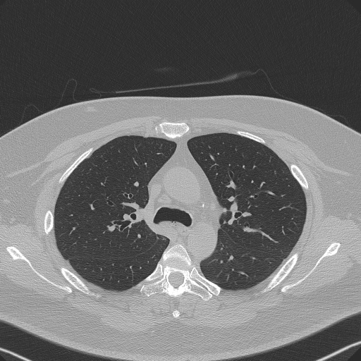 File:Adenoid cystic carcinoma of the trachea (Radiopaedia 49042-54137 Axial lung window 117).jpg