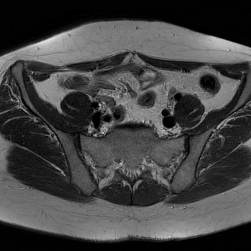 File:Adenomyosis-scar endometriosis (Radiopaedia 65863-75022 Axial T2 5).jpg