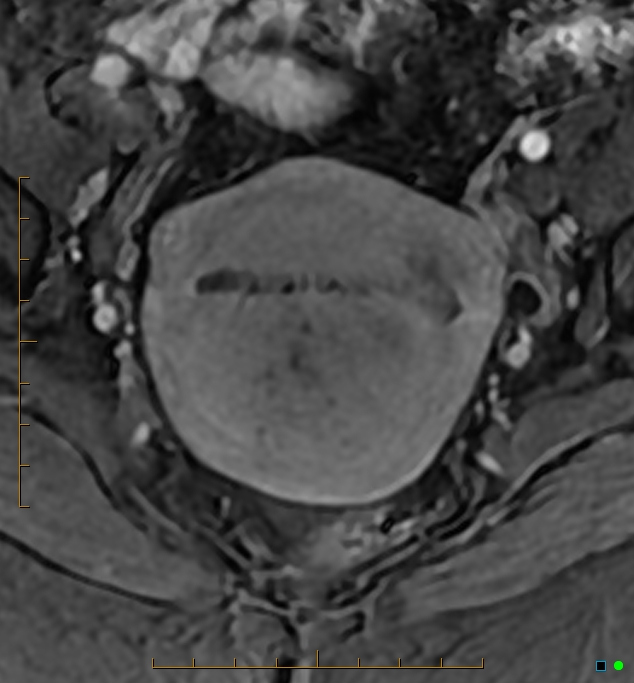 Adenomyosis uterus with hematometra (Radiopaedia 45779-50011 Axial T1 C+ fat sat 24).jpg